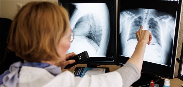 Ukraine-Krieg droht Ausbreitung von Tuberkulose und HIV zu begünstigen Eine Radiologin analysiert in der Lungenklinik Gauting die Röntgenbilder der Lunge einer aus der Ukraine geflüchteten Person. Der Krieg dort droht die Ausbreitung der Erkrankung zu begünstigen, warnt der Globale Fonds.