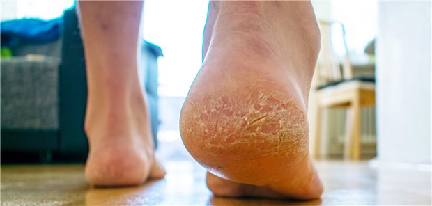 Eine Rhagade an der Ferse kann auch höllisch wehtun, so sehr, dass das Gehen zur Qual wird.
