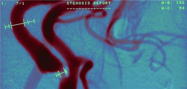 Eine Stenose der Arteria carotis geht nicht zwangsläufig mit Symptomen einher.