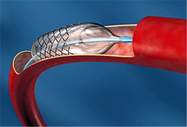 Wie Viel Prozent Bei Stent www.aerztezeitung.de