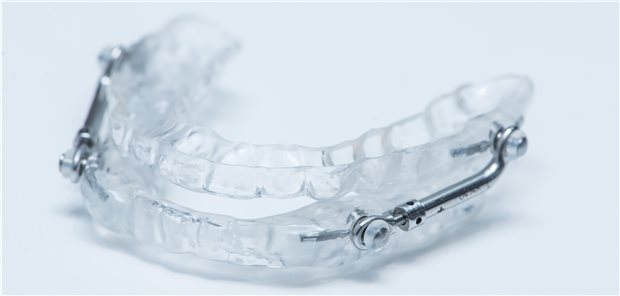 Eine Unterkieferprotrusionsschiene hält die Atemwege mechanisch offen.