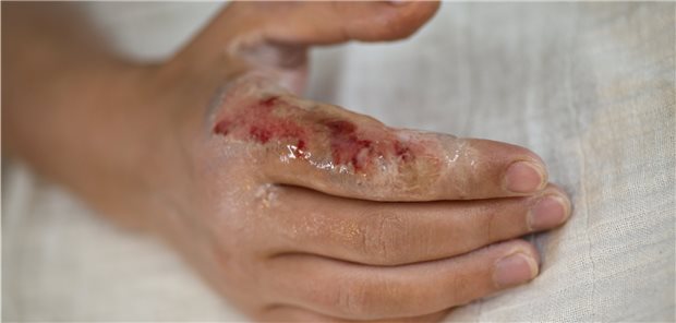 Eine akute Infektion verursacht eine Entzündung, die zur Bildung von Atherosklerose und Thromben beitragen kann.