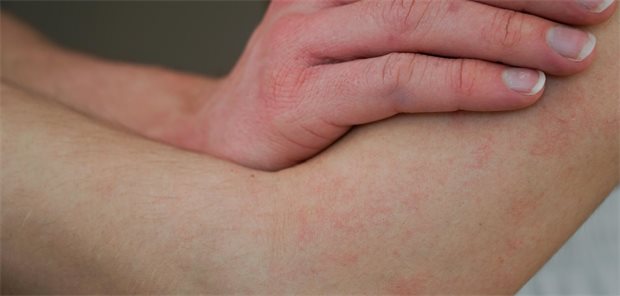 Eine atopische Dermatitis geht unter anderem mit Juckreiz einher. Laut Leitlinie "Atopische Dermatitis" werden Antihistaminika seit 40 Jahren zur Therapie der atopischen Dermatitis eingesetzt – allerdings ohne ausreichende Belege für ihre Wirksamkeit.
