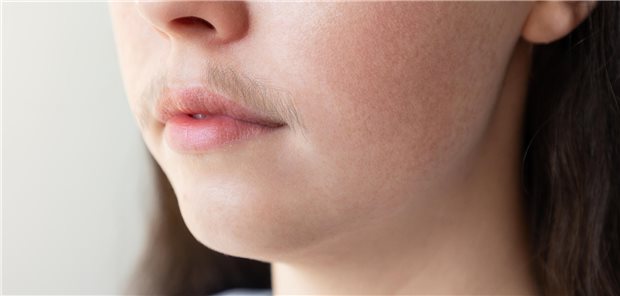 Eine australische Studie hat ergeben: Laser- und Lichttherapien allein oder in Kombination mit anderen Behandlungen können ermutigende Ergebnisse beim Verringern des Hirsutismus sowie beim Verbessern des psychischen Befindens und der Lebensqualität der betroffenen Frauen erzielen. (Symbolbild)
