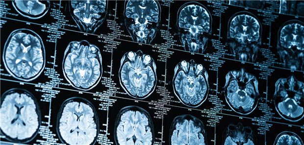 Diverse Scans einer MRT zeigen verschiedene Querschnitte eines menschlichen Schädels. 