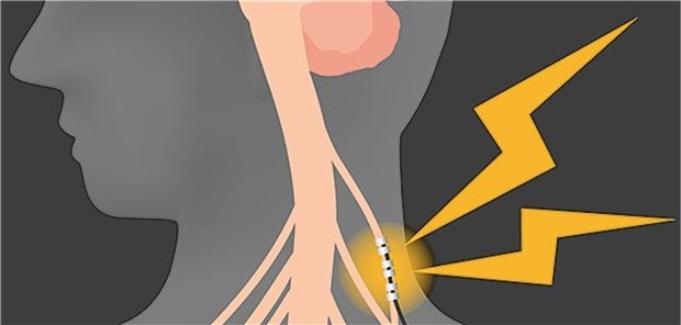 Eine elektronische Stimulation des Vagusnervs hat den TNF-a-Ausstoß signifikant reduziert. Das half einer kleinen Gruppe von Rheumatikern im Versuch.