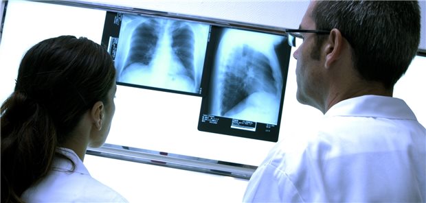 Eine erfolgreiche Option, Lungenkrebs früh und damit behandelbar zu erkennen, ist der Einsatz eines Lungenkrebs-Screenings. In Deutschland ist das noch nicht verfügbar.