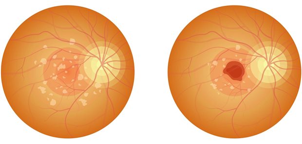 Eine feuchte Maculadegeneration (rechts) ist gekennzeichnet durch die Choroidea-Neovaskularisation. Unbehandelt ist eine disziforme Narbe unter der Makula die Folge, die zu einer lokalisierten Ablösung des retinalen Pigmentepithels führt. Es kommt zu einem schnellen Visusverlust. Bei einer trockenen AMD (links) hingegen verändert sich das retinale Pigmentepithel, was zu einem sukzessiven Sehverlust über Jahre führt.