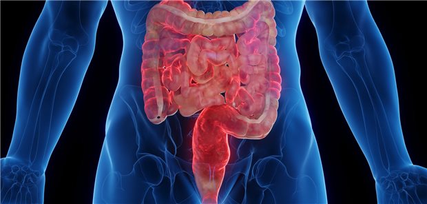 CED: Hohe Persistenz mit modernen Therapeutika Dreidimensionale medizinische Illustration des von Morbus Crohn betroffenen Darms eines Mannes.