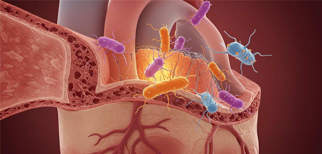 Common Endocarditis Symptoms: Musculoskeletal Manifestations - News Directory 3
