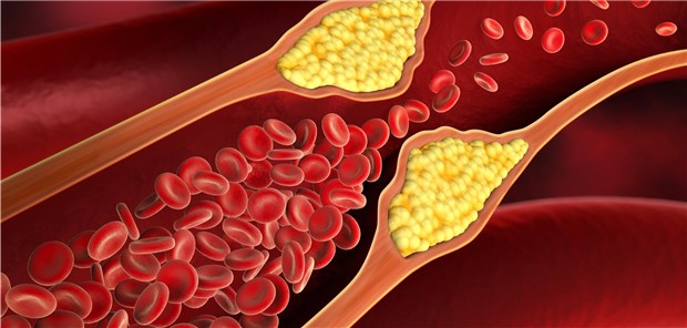 Eine intensive DL-Cholesterin-Senkung schützt offenbar Herz- und Hirngefäße.