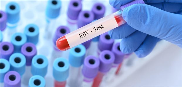 Ein Forscher untersucht eine Blutprobe auf der EBV-Test steht