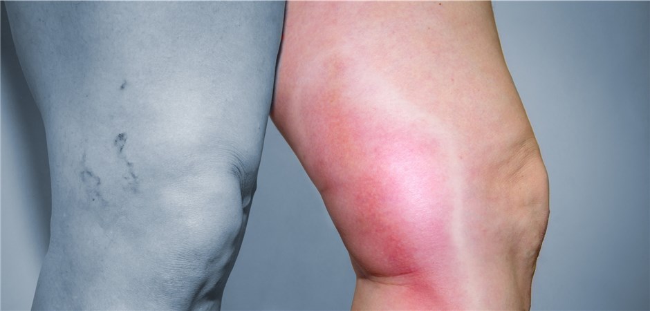 Thrombophlebitis gilt als phlebologischer Notfall