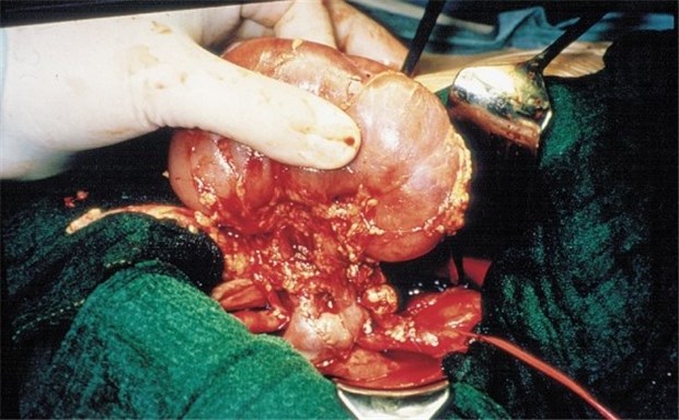 Anonyme Organspende erleichtert Überkreuz-Transplantation Einem Organspender wird gerade eine Niere entnommen. In Deutschland müssen sich Paare bei Überkreuzspenden persönlich kennen.