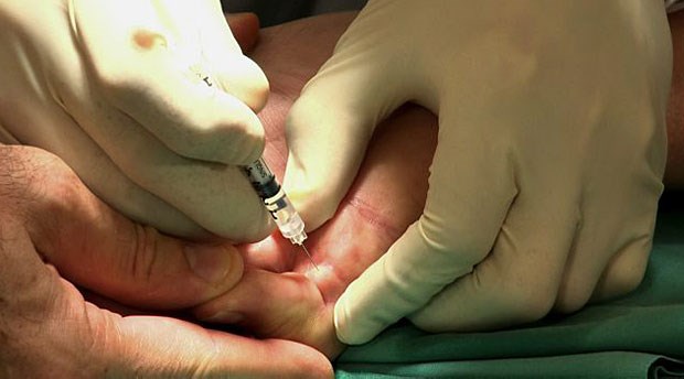 Einem Patienten mit M. Dupuytren wird die Kollagenase injiziert.