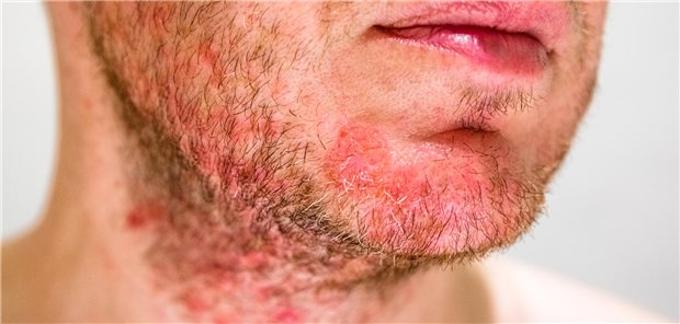 Nahaufnahme des Kinns eines Mannes mit seborrhoischer Dermatitis im Bartbereich.