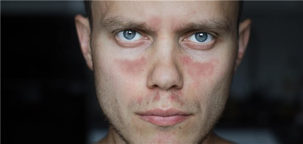 Nahaufnahme des Gesichte eines Mannes mit schmetterlingsförmigen Ausschlag im Gesicht, der charakteristisch für die Autoimmunerkrankung systemischer Lupus erythematodes ist.