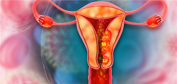 Erkrankungen des weiblichen Fortpflanzungssystems. Dreidimensionale Illustration von endometrialen bösartigen Tumoren.