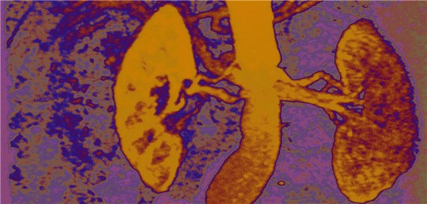 Einer Studie zufolge hat es keinen relevanten Einfluss auf das Fortschreiten einer schweren Niereninsuffizienz, wenn Renin-Angiotensin-Inhibitoren abgesetzt oder weiter eingenommen werden. (MRT-Falschfarben-Schichtbild)
