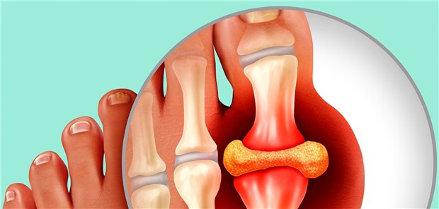 Computerillustration: durch Ablagerungen von Harnsäurekristallen entzündete, geschwollene Großzehe.
