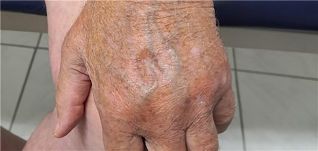 Eingedrücktes Ödem an der Hand eines Patienten mit RS3PE-Syndrom.