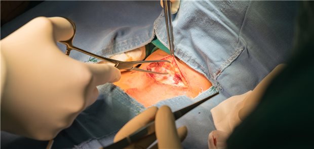 Eingriff an der Schilddrüse – hier ist die Erfahrung des Chirurgen/der Chirurgin gefragt. Denn, ist die Zahl der Operationen gering und liegt unter 50 pro Jahr, ist das Risiko einer Stimmlippen-Parese wohl deutlich erhöht.