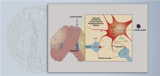 Eladocagene exuparvovec wird in das Putamen injiziert und liefert über den Vektor rAAV2 die für das AADC-Enzym kodierende cDNA. Die Expression von AADC ermöglicht die Dopamin-Synthese.