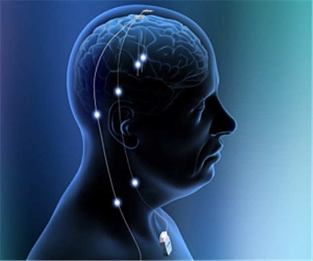 Tiefe Hirnstimulation gegen Alzheimer? Elektroden im Hirn - womoglich eine Option gegen Alzheimer.