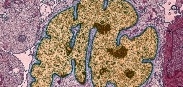 Elektronenmikroskopische Aufnahme eines Lungenkarzinoms. Heute erlaubt die molekulardiagnostische Charakterisierung eine immer zielgerichtetere Therapie.