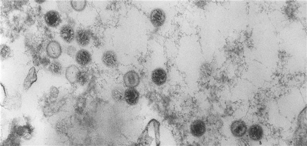 Elektronenmikroskopische Aufnahme von Epstein-Barr-Viren (EBV): Die Antikörperantwort bei Infektion mit EBV scheint sich maßgeblich von jener bei anderen viralen Infektionen zu unterscheiden.