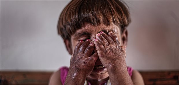 Elfjähriges Mädchen mit Pemphigus vulgaris im Kriegsgebiet von Syrien.