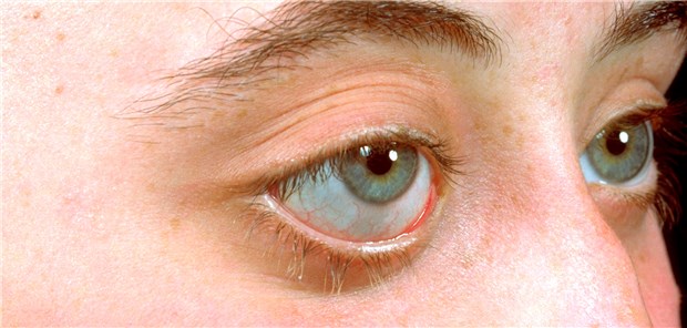 Endokrine Orbitopathie: Unter einer Antikörper-Therapie rücken die Augen zurück.