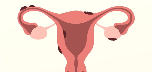Illustration der Auswirkung einer Erkrankung an Endometriose auf den Uterus einer Frau.