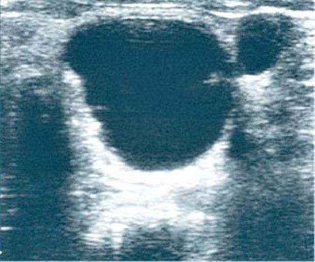 Erste Symptome 2001, Diagnose 2011 Endometriose des Ovars.
