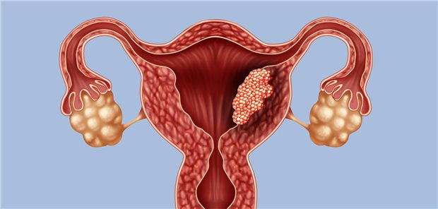 Endometriumkarzinom: Neue Kombinationstherapie aus Pembrolizumab plus Lenvatinib