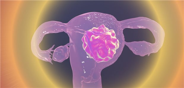 Endometriumkarzinom: Dostarlimab als Immuntherapie verfügbar