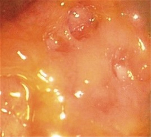 "Einmal täglich" ist bei Colitis oft genug Endoskopische Aufnahme bei Colitis ulcerosa: Schleimhaut mit mehreren Ulzera.