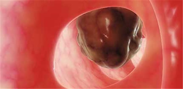 Neue Optionen für die Arzneimittel-Therapie Endoskopische Aufnahme eines Darmtumors.