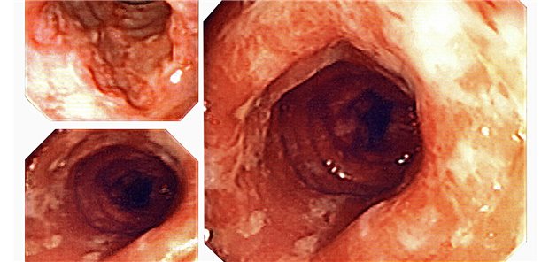Endoskopischer Befund bei Morbus Crohn.