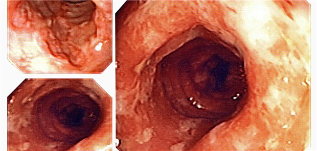 Endoskopischer Befund bei Morbus Crohn. Von 5-ASA bis zu Biologika gibt es mittlerweile eine große Auswahl hier zugelassener Arzneien. Bei manchen Betroffenen ist auch die Operation eine passende Therapieoption.