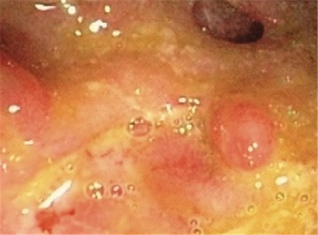 Spezialfett - neu bei Colitis ulcerosa Endoskopisches Bild bei akuter Colitis ulcerosa mit entzündlichen Pseudopolypen.
