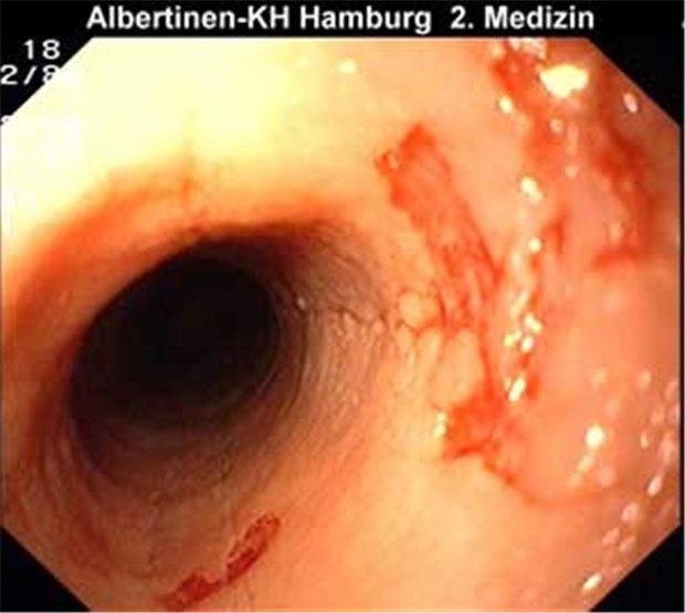 Neue Wege bei der Eosinophilen Ösophagitis Endoskopisches Bild einer histologisch gesicherten Eosinophilen Ösophagitis.