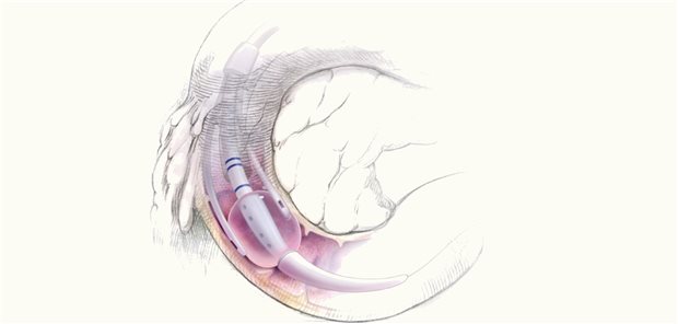 Endoskopisches „Duodenal Mucosal Resurfacing“: Mit einem speziellen Katheter wird Duodenalschleimhaut auf einer Länge von etwa 10 cm mit Hitze abladiert. Die Mukosa regeneriert sich binnen weniger Tage, morphologische und funktionelle Veränderungen normalisieren sich.
