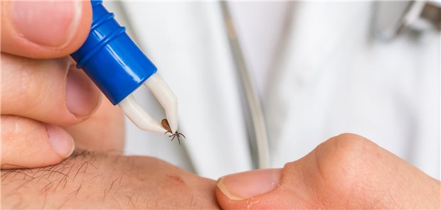 Eine Zecke wird mit einer Zange aus der Haut entfernt.