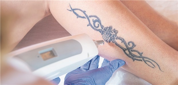 Entfernung eines Tattoos per Laser: Bei richtiger Wellenlänge wird das Gewebe nicht verletzt.