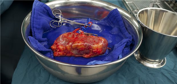 Gesundheitsministerium prüft Über-Kreuz-Lebendnierenspende Entnommene Niere bei einer Nierentransplantation in einer Klinik in Nordrhein - Westfalen. Die anonyme Lebendspende von Nieren wird Thema im Bundestag.