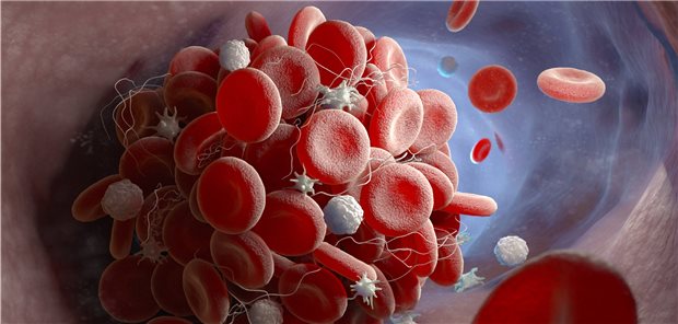 Entstehung einer Thrombose: Eine Thrombophilie sollte nur bei ausgewählten Patienten abgeklärt werden.