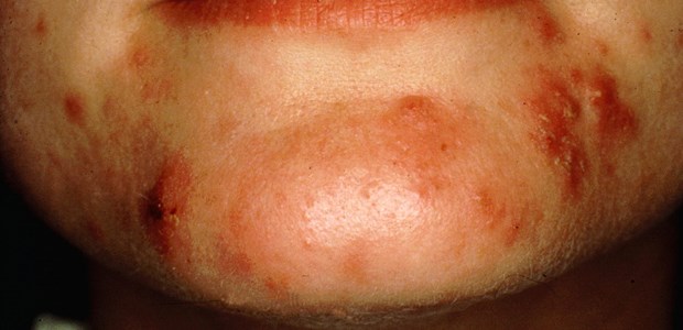 Fibroblasten gegen Akne Entwickeln sich Aknepusteln zu -narben kann eine Injektion von körpereigenen Fibroblasten helfen.