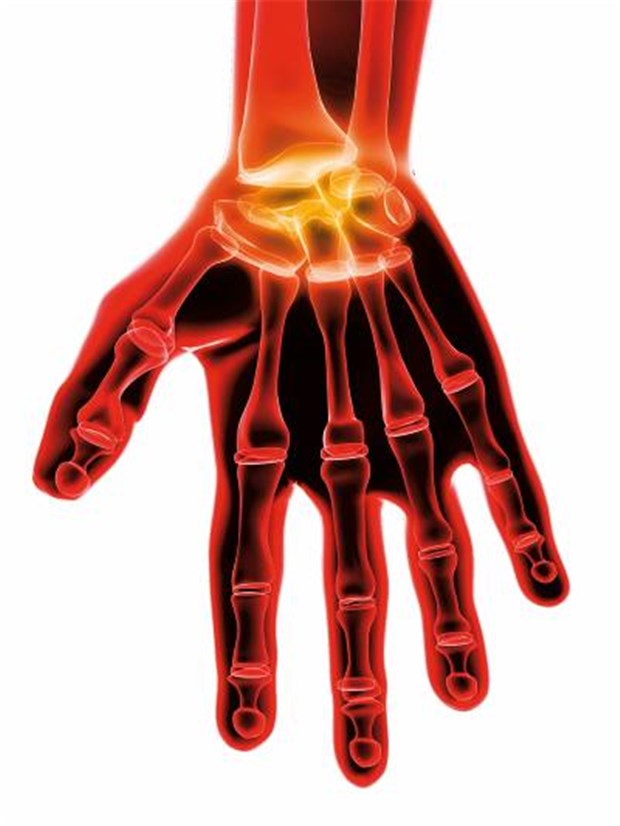 Neue Daten stützen Kombitherapie bei RA Entzündete Gelenke der Hand eines Patienten mit Rheumatoider Arthritis.