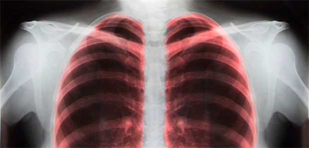 Entzündete Lungen - plastisch dargestellt.